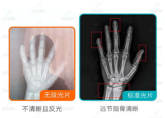 網(wǎng)上問診需要提供什么樣的骨齡片？.gif