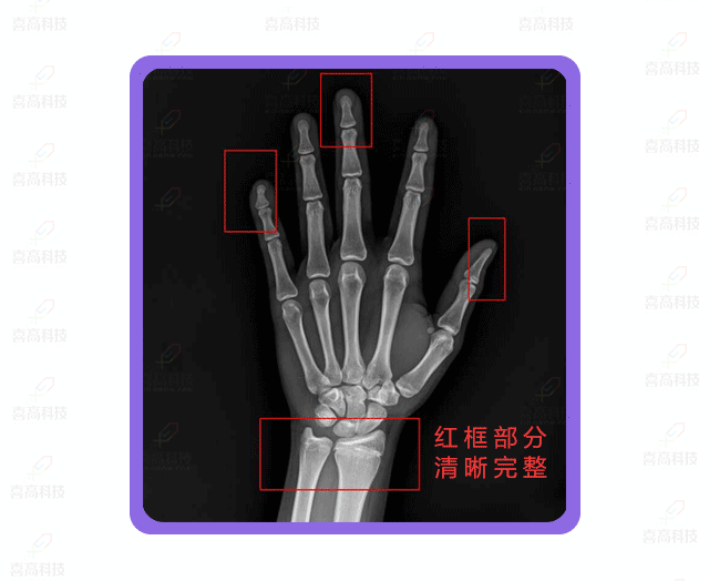 如何拍好手腕部X光片？怎樣做好防護(hù)？.gif